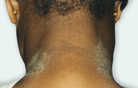 Eczema on back of neck
