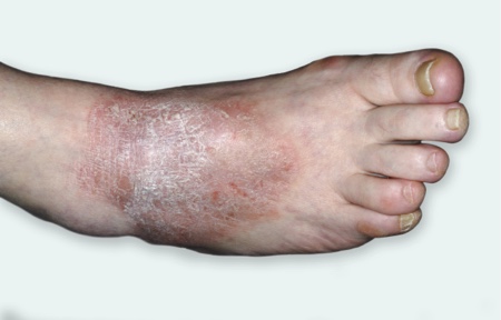 Eczema on ankle