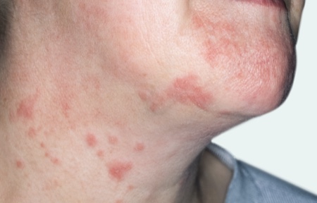 Eczema on chin