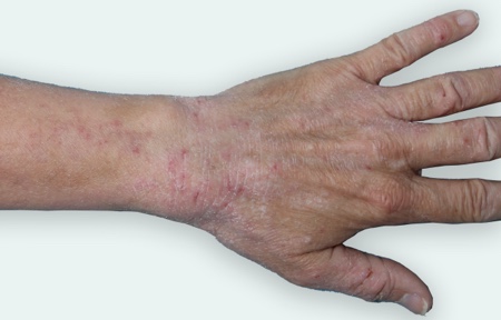 Eczema on hand and wrist