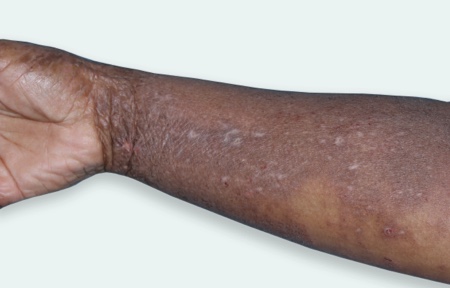 Eczema on wrist