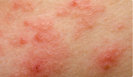 Picture of Eczema